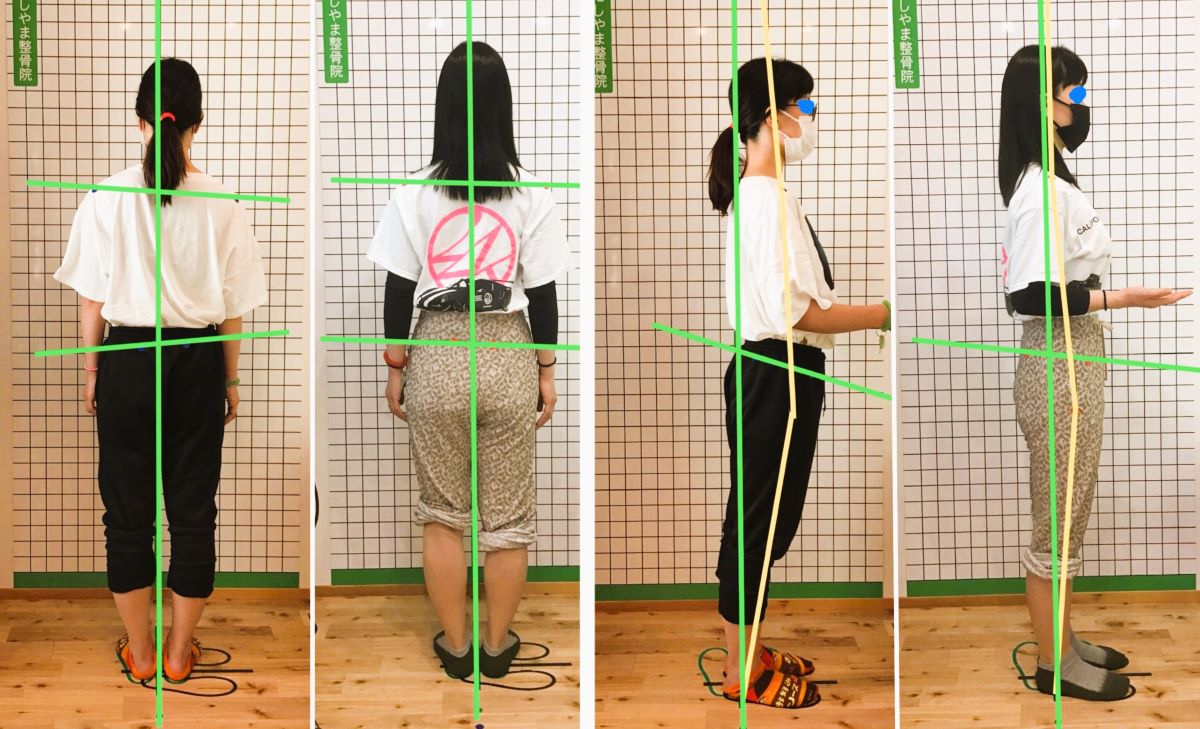 姿勢評価（来院時／施術後）